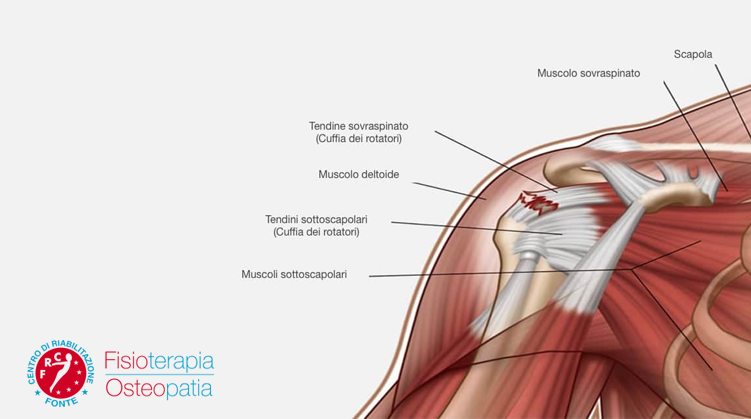 Tendinite della spalla esercizi e terapia