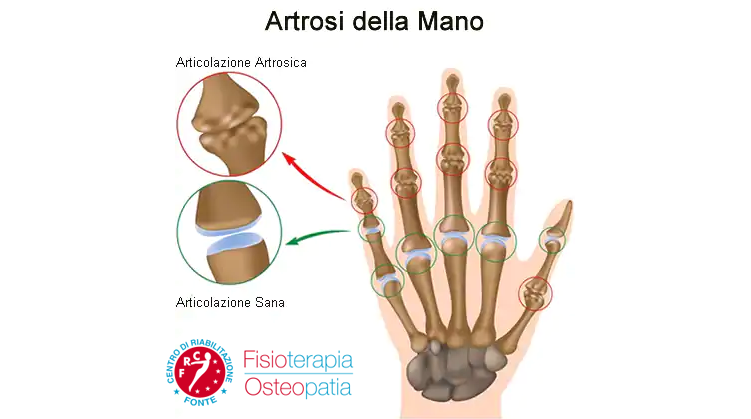 Artrosi della mano