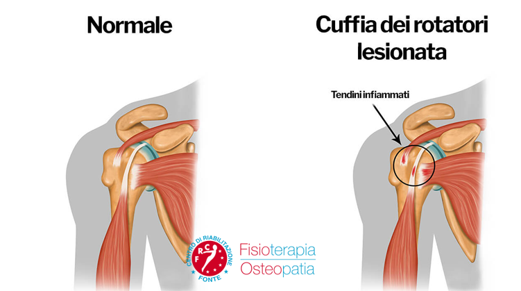 Cuffia rotatori lesionata