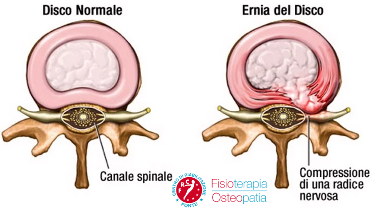 Ernia del disco cosa è