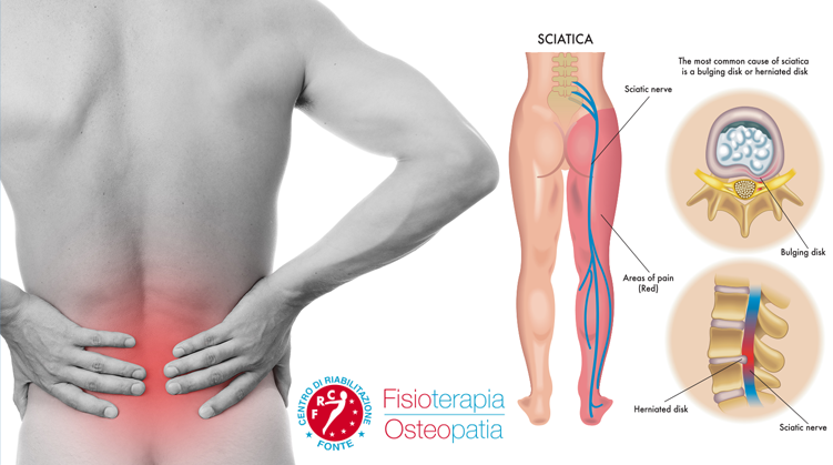 Sciatica: rimedi per il nervo sciatico infiammato + VIDEO ESERCIZI -  Osteoclinic