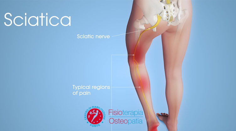 Sciatica perchè viene