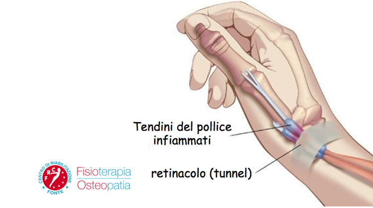 Tendini mano infiammati