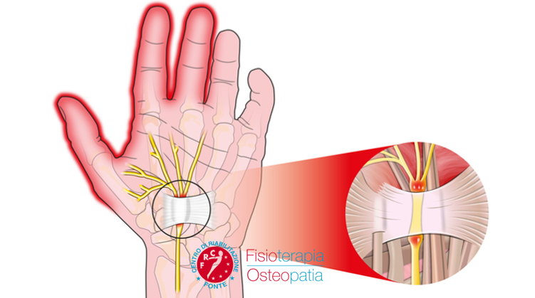 Sintomi tunnel carpale